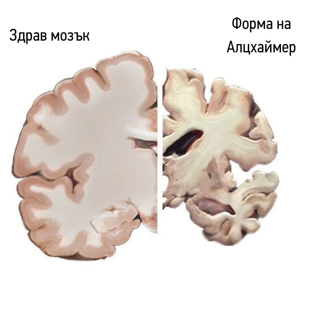 Диагностика и лечение при болестта на Алцхаймер