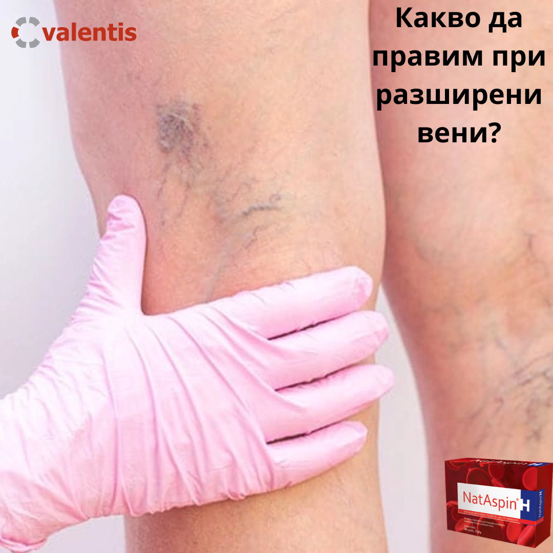 Имам разширени вени – как да си помогна?