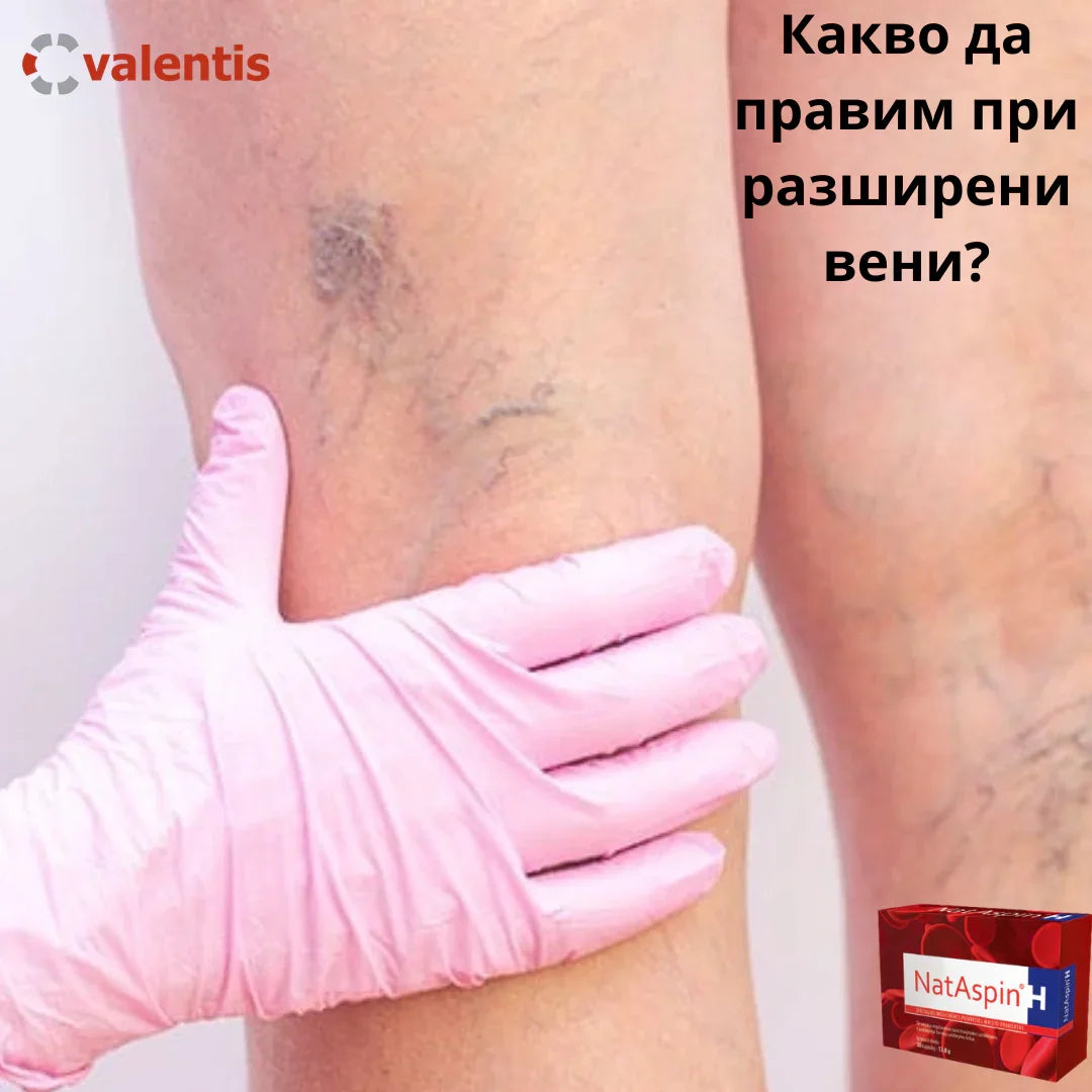 Имам разширени вени – как да си помогна?